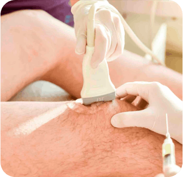 Hidrodissecção para dor neuropática guiada por ultrassom